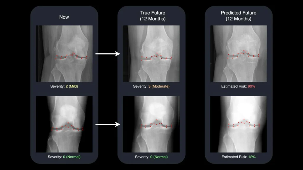 AI turns x-rays into time machines for arthritis care